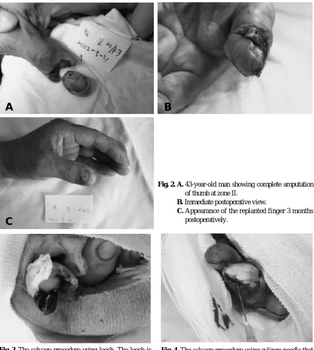 Fig. 2. A. 43-year-old man showing complete amputation of thumb at zone II. 