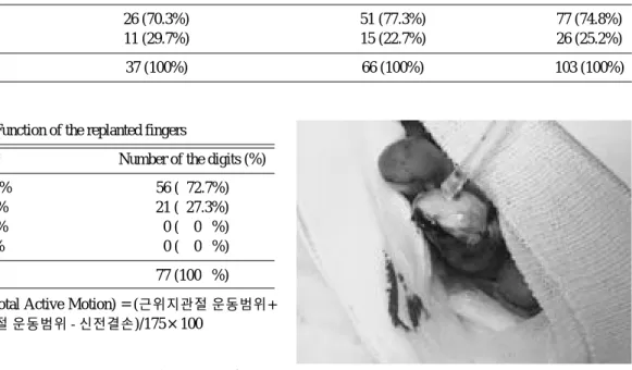 Fig. 5. When the circulation is doubtful, the replanted finger is got wet with saline solution.