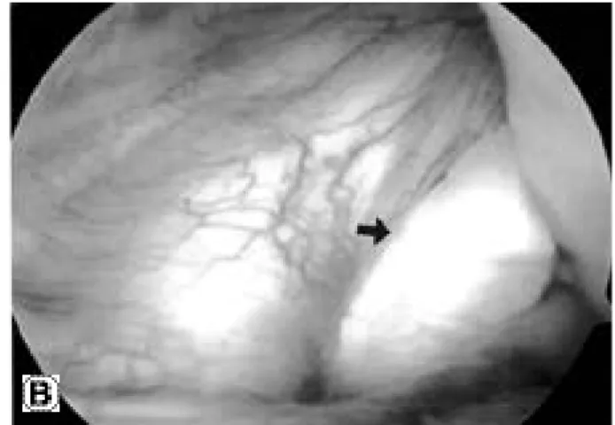 FIGURE 6. Second look arthroscopic finding of PCL(arrows) 6 months after hamstring PCL reconstruction through anterolateral portal(A), and posteromedial portal(B).