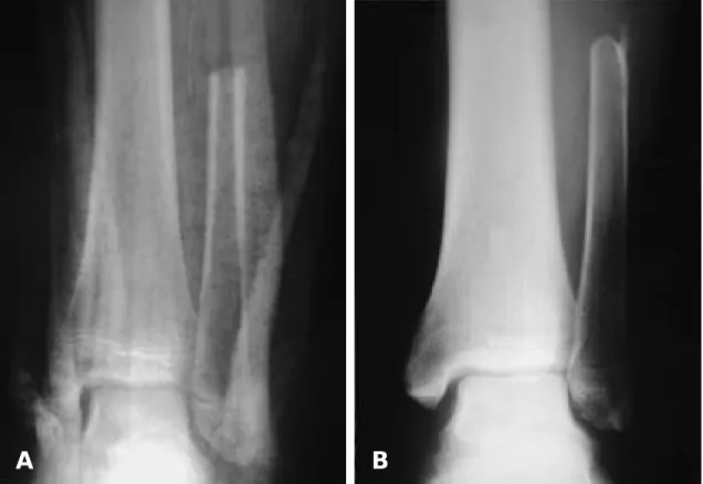 Fig. 4. A. A 13-year-old boy was treated with a vascularized fibular graft without tibiofibular synostosis of donor site Fig