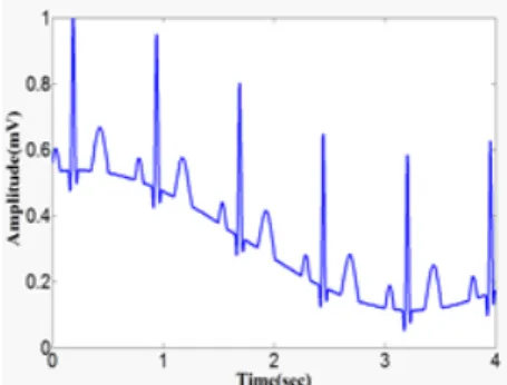 Fig. 5. Baseline wanders reduction from ECG signal  using NLMS filter 베이스  라인  드리프트는  Fig