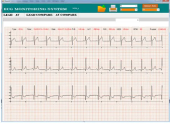 Fig. 12. ECG data output of Windows viewer screen