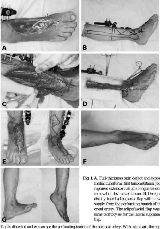 Fig. 1. A. Full-thickness skin defect and exposure of medial cuneiform, first tarsometatarsal joint, and ruptured extensor hallucis longus tendon after removal of devitalized tissue