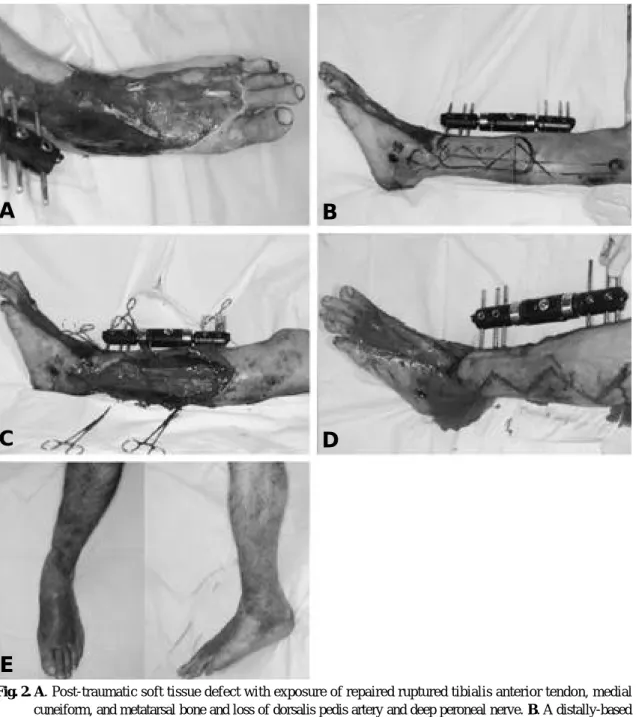 Fig. 2. A. Post-traumatic soft tissue defect with exposure of repaired ruptured tibialis anterior tendon, medial cuneiform, and metatarsal bone and loss of dorsalis pedis artery and deep peroneal nerve