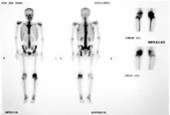 Fig. 2. Whole body bone scan with Tc-99m-HDP 20McI .  Hot uptake of left knee area was noted and abnormal uptake was not seen other skeleton.