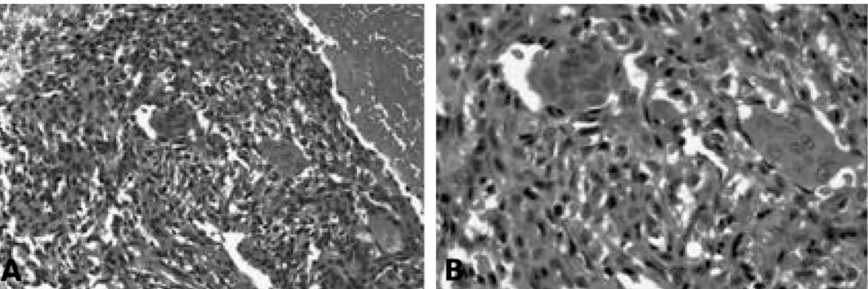 Fig. 5. Magnetic resonance image at a postoperative 8 months. ( A) and (B) Multiple fluid-fluid level within mass like lesion was noted at medial aspect of patella