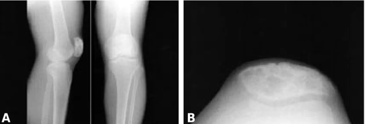 Fig. 7. Magnetic resonance image at a postoperative 17 months. (A) and (B) Multiple fluid-fluid level within mass like lesion was noted at medial aspect of patella and no significant interval change in the apperance on the MRI at a postoperative 8 months w