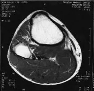 Fig. 2. T2-weighted images(TR/TE: 4500/96) at the same level as Fig.1 showing the high signal from the cyst.
