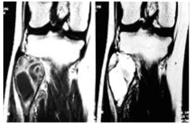 Fig. 1. Preoperative plain radiographs showing the clas- clas-sic features of a giant cell tumor, including faint trabeculation and mild osseous expansion, involving proximal portion of right fibula.