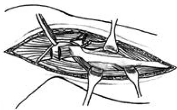 Fig. 6. Postoperative plain radiographs following en block resection and fibula collateral ligament reconstruction with non absorbable suture and staple .