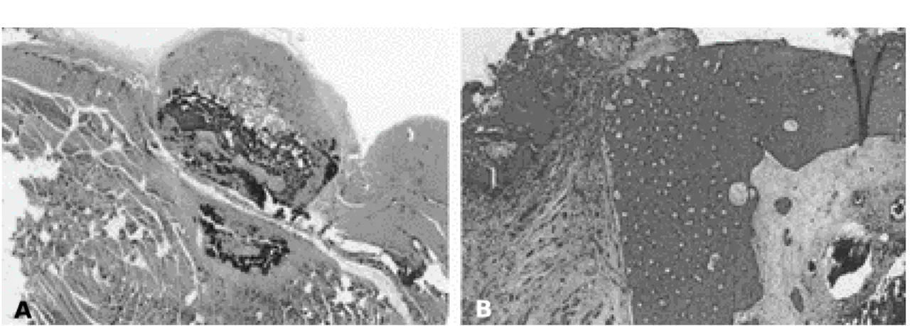 Fig. 3. A) At 4 weeks, muscles contacted to the holmium-166 attached gelatin sponge (upper) showed necrosis and calcification (lower) in low power view ( ×40, H&amp;E stain).