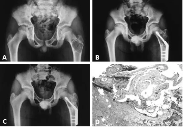 Fig. 3. Aneurysmal bone cyst of proximal femur in a 12-year-old patient 