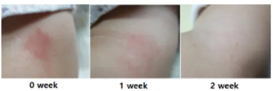 Fig. 5. Change of symptoms after using A.C.C. extracts  (n=18). *, p < 0.05, and ***, p  < 0.001  compared to 0 week