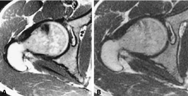 Fig. 3. R a d i o n i c s ® probe is positioned in the center of the lesion. 80℃ heat was applied for 6 minutes on average mode.