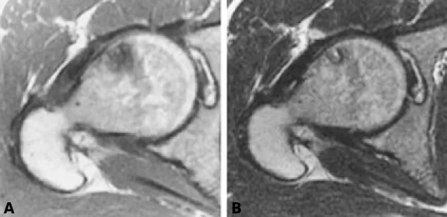 Fig. 5. Microscopically this lesion contains benign appearing chondrocyte under cortical bone area (H&amp;E, X400)