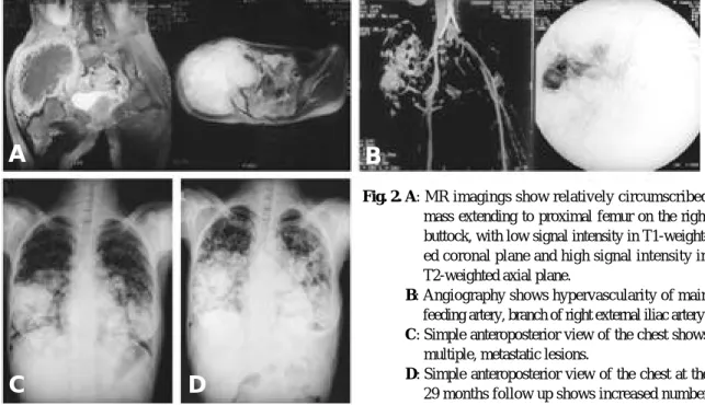 Fig. 2. A: MR imagings show relatively circumscribed mass extending to proximal femur on the right buttock, with low signal intensity in  T1-weight-ed coronal plane and high signal intensity in T2-weighted axial plane