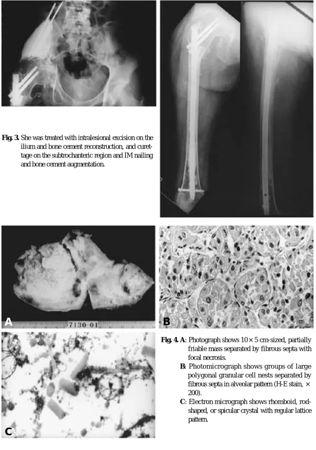 Fig. 3. She was treated with intralesional excision on the ilium and bone cement reconstruction, and  curet-tage on the subtrochanteric region and IM nailing and bone cement augmentation.