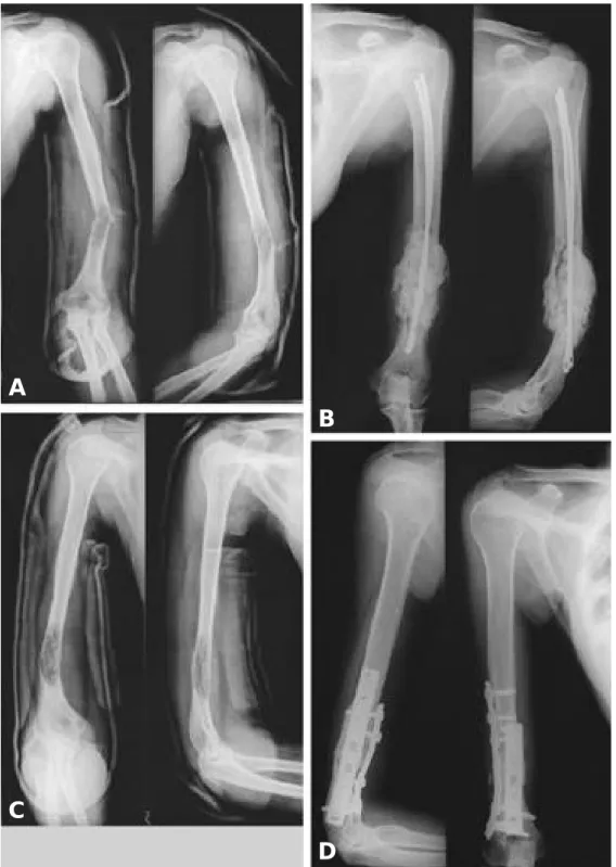 Fig. 7.A : At postoperative 12 months, pathologic fracture on the left distal humerus.