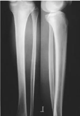 Fig. 10. Postoperative roentgenogram shows wide mar- mar-ginal excision including lateral gastrocnemius