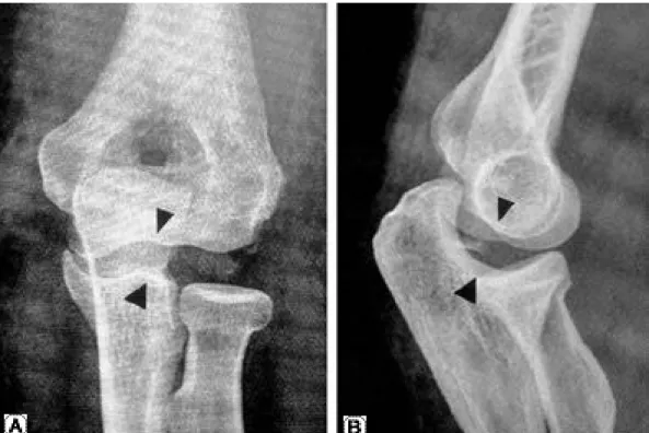 Fig. 1. An initial AP and lateral plain radiographs show incongruence of the elbow joint with opening of  lateral joint space(arrow heads).