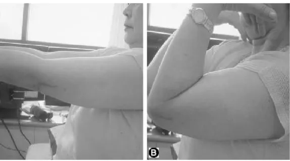 Fig. 5. At final follow up, patient presented almost full range of motion without evidence of elbow instability