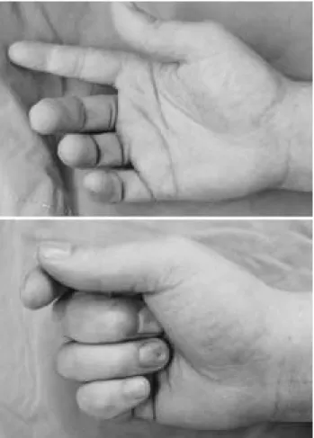 Fig. 2. Radiogragh of the right forearm on admission.