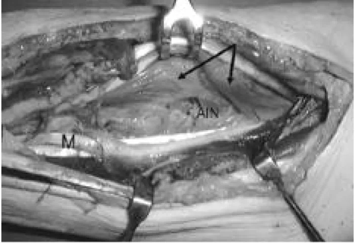 Fig. 3.  Photograph shows the bone cement covered between anterior surface of the radius and the removed plate