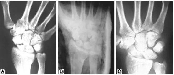 Fig. 3. A . Preoperative ulnar deviation radiograph of the left wrist of a twenty-one-year-old man