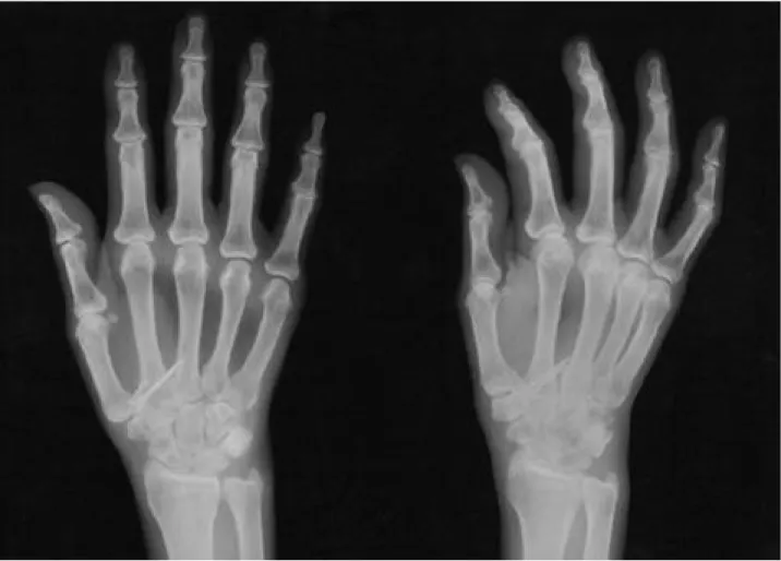Fig. 3. Postoperative X-ray shows the fragment reduced by internal fixation with k-wires and tension band wiring