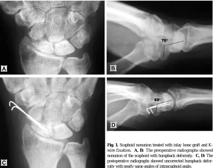 Fig. 1. Scaphoid nonunion treated with inlay bone graft and K- K-wire fixation.   A, B:  The preoperative radiographs showed nonunion of the scaphoid with humpback deformity