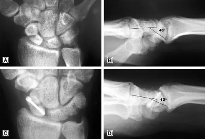 Fig. 2. Scaphoid nonunion treated with anterior interpositional wedge bone graft and Herbert screw fixation