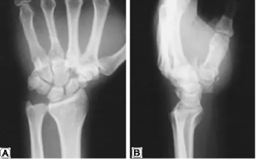 Fig. 2. Computed tomography show overlap of metacarpal dor - -sal to carpal bone.