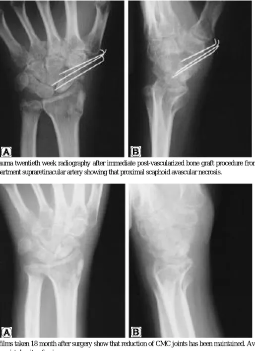 Fig. 7-A, B. X-ray films taken 18 month after surgery show that reduction of CMC joints has been maintained