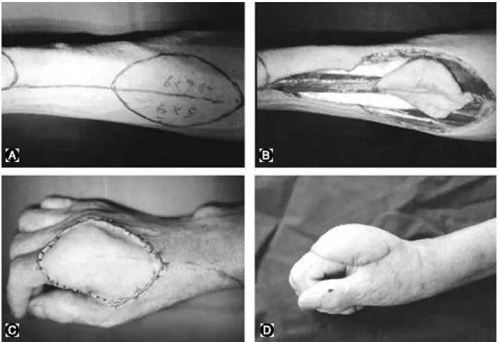 Fig. 2-A. Photograph showing the schematic drawing of reverse radial forearm flap. 