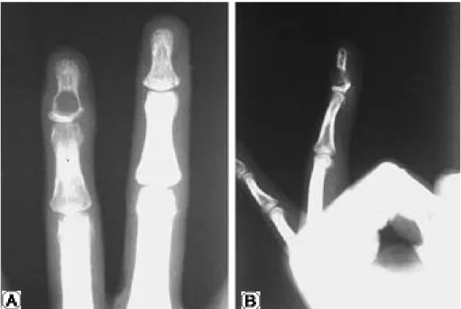 Fig. 1. Anteroposterior view ( A) and lateral view (B) of the simple radiograph of the distal phalanx show a well-marginated expan- expan-sile osteolytic lesion with a thinned cortex.