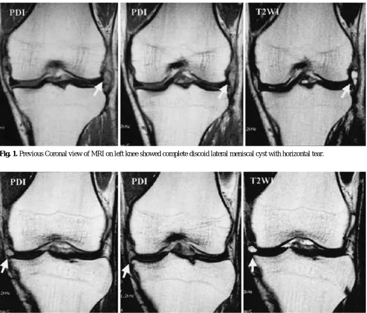 Fig. 2. Arthroscopic view of a remaining lateral meniscus rim following arthroscopic partial meniscectomy &amp; cyst decompression.