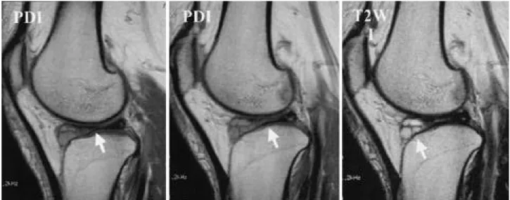 Fig. 7. Previous Coronal view of MRI on left knee showed complete discoid lateral meniscal cyst with horizontal tear.