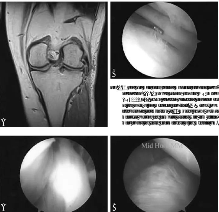 Fig. 2. 40 year old male after ACL reconstruction and medial meniscus allograft transplantation ( A) Second look arthroscopic exami- exami-nation at 14 months shows good vascularization and normal tension of the ACL graft (B) Second look arthroscopic  exam