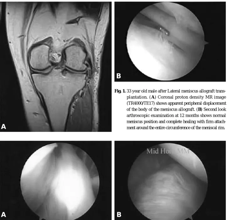 Fig. 2. 40 year old male after ACL reconstruction and medial meniscus allograft transplantation ( A) Second look arthroscopic exami- exami-nation at 14 months shows good vascularization and normal tension of the ACL graft (B) Second look arthroscopic  exam