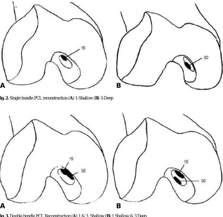 Fig. 3. Double bundle PCL Reconstruction (A) 1 &amp; 3  Shallow (B) 1 Shallow &amp; 3 Deep