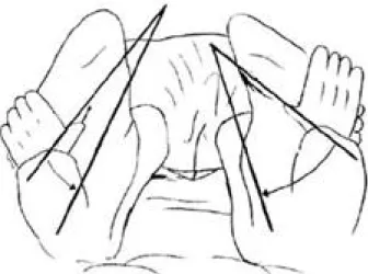 Fig. 4. External rotation of the affected foot relative to the thigh is compared to normal side (knee flexion 30° &amp;