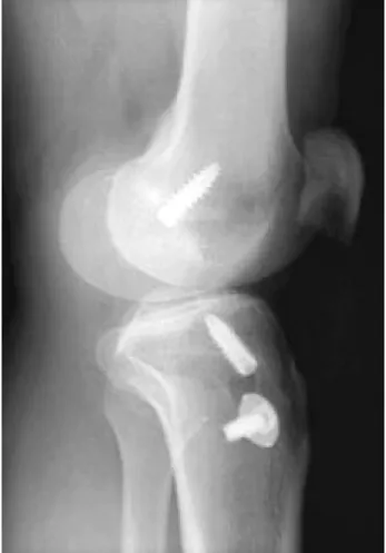 Table 2. Cause of failure after ACL reconstruction