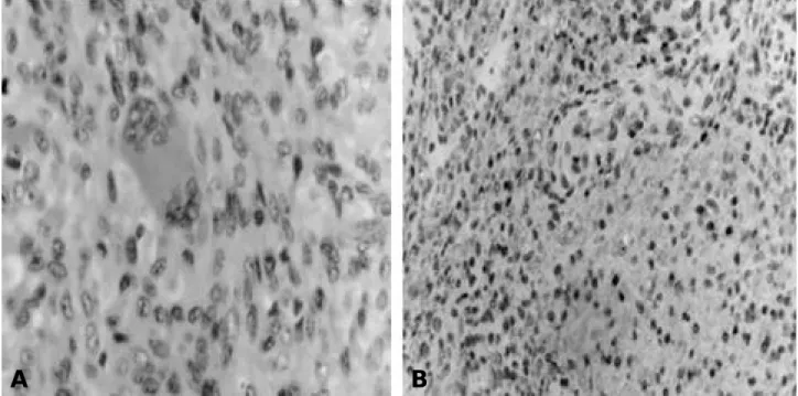 Fig. 3. (A) In H-E staining ( ×400), the macrophage infiltration with the formation of giant cell was viewed