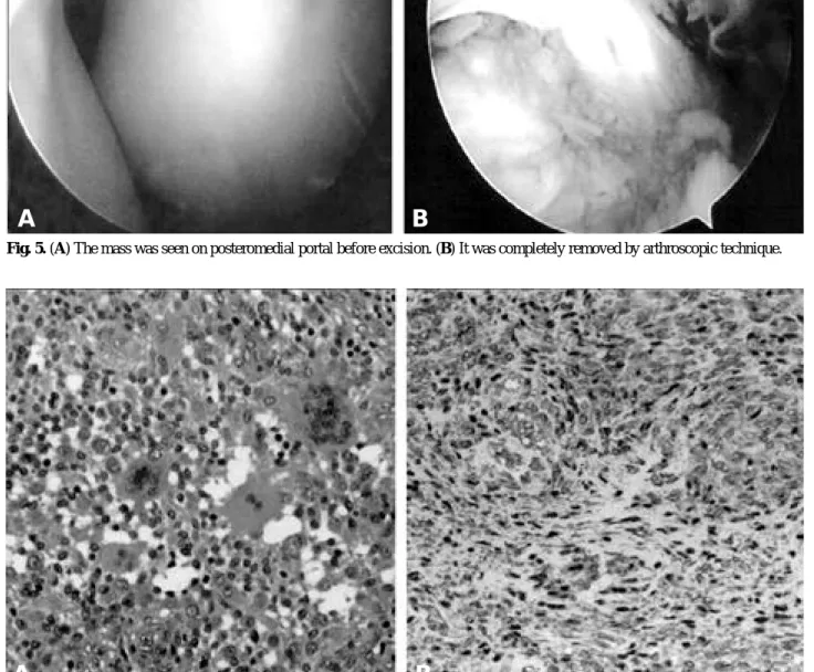 Fig. 6. (A) In H-E staining ×(400), Macrophage infiltration with the formation of giant cell was viewed