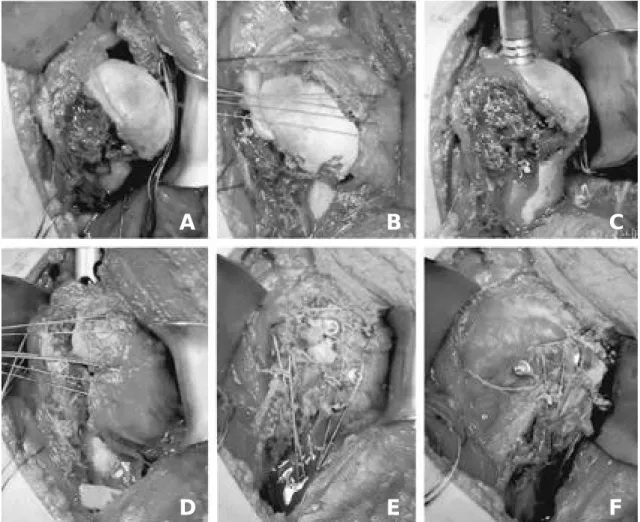 Fig. 2. (A) Exposure of proximal humeral fracture through deltopectoral approach. (B) Using the traction sutures to the greater or lesser tuberosity fragment for the minimizing the manipulation