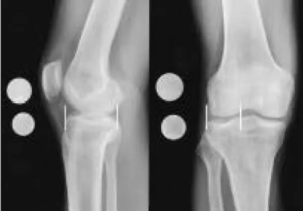 Fig. 2. This picture shows insertion of allograft lateral meniscus by key hole technique