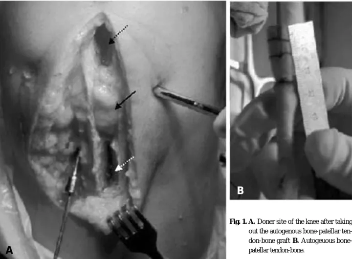 Fig. 1. A . Doner site of the knee after taking out the autogenous bone-patellar  ten-don-bone graft  B 
