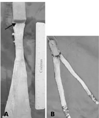 Fig. 4. A . Achilles tendon allograft which has thick collage- collage-nous tissue &amp; enough length