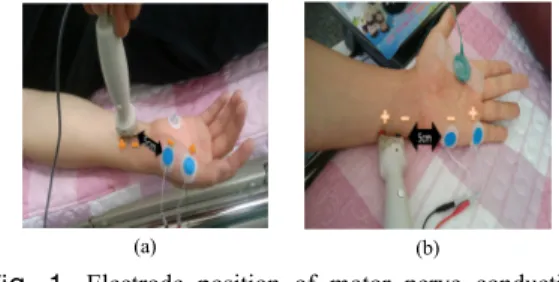 Fig. 1. Electrode position of motor nerve conduction  study in median and ulnar nerve