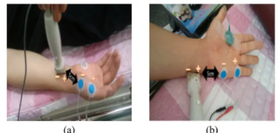 Fig. 3. Electrode position of F wave nerve conduction  study in median and ulnar nerve